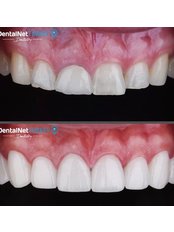 Dental Crowns - Dental Net Turkey