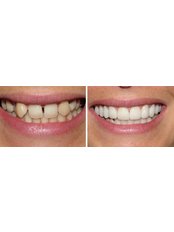 Dental Bonding - dentalcosmeticturkey