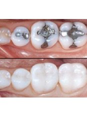 Chipped Tooth Repair - dentalcosmeticturkey