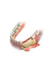Bone Graft - dentalcosmeticturkey