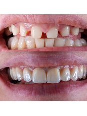 Zirconia Crown - DENTANTALYA Dental Clinic