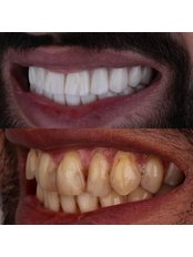 Lumineers™ - DENTANTALYA Dental Clinic