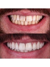 Dental Crowns - DENTANTALYA Dental Clinic