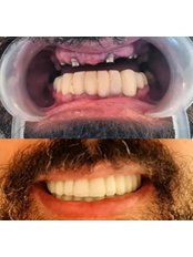 Dental Implants - Dentocareturkey