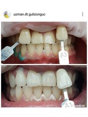 Laser Teeth Whitening - Dentocareturkey