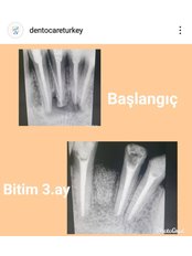 Bone Graft - Dentocareturkey