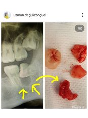 Wisdom Tooth Extraction - Dentocareturkey