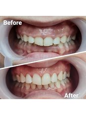 Gum Contouring and Reshaping - Dentocareturkey