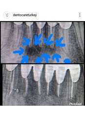 Root End Surgery - Dentocareturkey