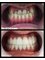 DentOdream Ltd / Dental Dream Turkey - Massive dental transformation without any tooth extraction 