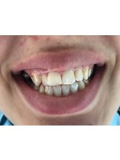 Zirconia Crown - DentOdream Ltd / Dental Dream Turkey
