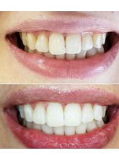 Chemical Teeth Bleaching - Dr. Ezgi Özkan Özben