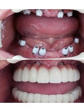 Dental Implants - Dr. Ezgi Özkan Özben
