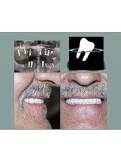 Dental Implants - Eksen Dental Clinic