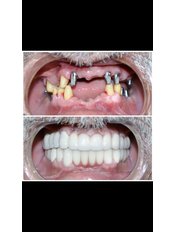 Dental Implants - Eksen Dental Clinic