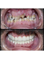 Dental Crowns - Eksen Dental Clinic