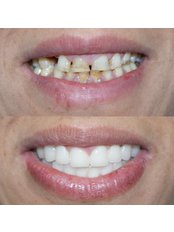 Zirconia Crown - Eksen Dental Clinic