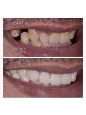 Zirconia Crown - Eksen Dental Clinic