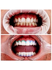 Teeth Whitening - Ezgi's Smile House