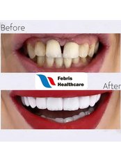 E-max Laminate Veneers - Febris Healthcare- Dental