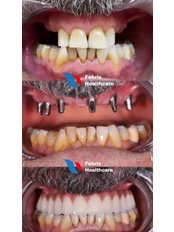 All-on-6 Dental Implants - Febris Healthcare- Dental