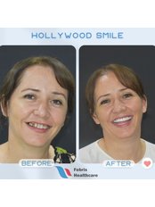 Hollywood Smile - Febris Healthcare- Dental