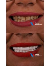 Smile Makeover - Febris Healthcare- Dental