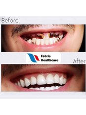Hollywood Smile - Febris Healthcare- Dental