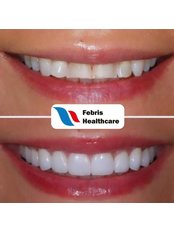 Laminates Porcelain Veneers (Emax) - Febris Healthcare- Dental