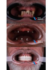 All-on-4 Dental Implants - Febris Healthcare- Dental