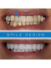 Smile Makeover - Febris Healthcare- Dental