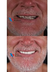 E-max Laminate Veneers - Febris Healthcare- Dental