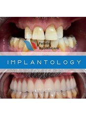 Dental Implants - Febris Healthcare- Dental