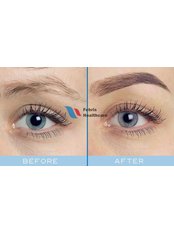 Eyebrow Transplant - Febris Healthcare