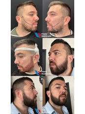 Beard Transplant - FEBRIS HEALTHCARE