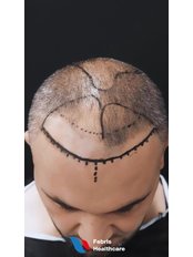 Hair Loss Specialist Consultation - Febris Healthcare