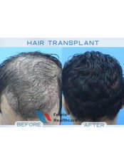 DHI Hair Transplant - FEBRIS HEALTHCARE