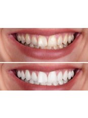 Teeth Whitening - Health House Life