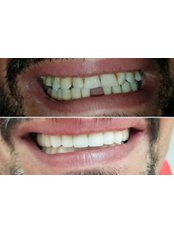 Zirconia Crown - Konyaaltı Dental Clinic