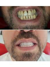 Veneers - Konyaaltı Dental Clinic