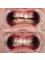 Lara Smile - Laser Teeth Whitening 