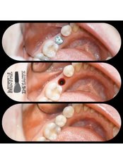 Dental Implants - Lara Smile