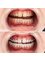 Lara Smile - Laser Teeth Whitening 