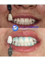Teeth Whitening - Magictouch Dental Clinic