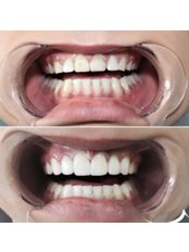 Ceramic Dental Crowns - Med and Dent