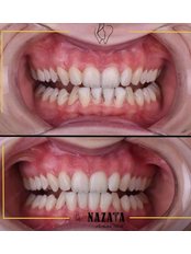 Teeth Cleaning - Nazata Dental