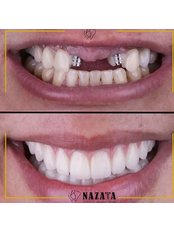 Dental Implants - Nazata Dental