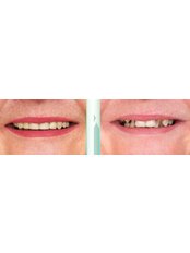 Hollywood Smile - Novus Dental Clinic