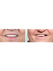 Dental Implants - Novus Dental Clinic