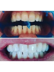 Teeth Whitening - Oris Dental Turkey